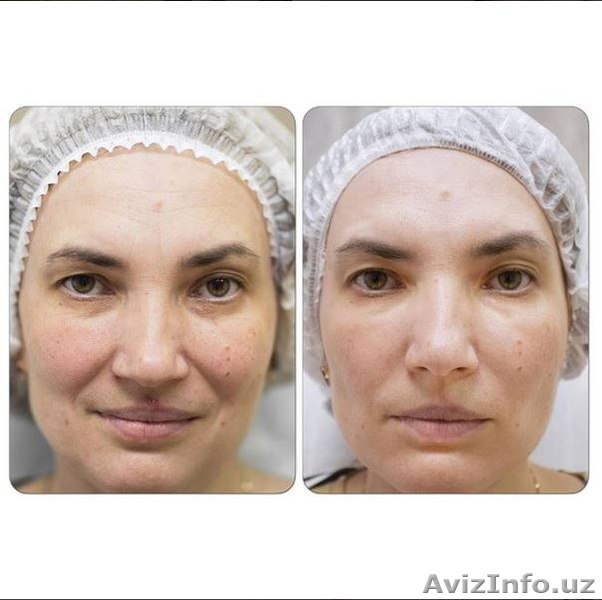 Летние нанно пилинги!!! - Изображение #1, Объявление #1200875