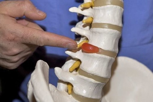 Лечение грыж!!! - Изображение #1, Объявление #1680666