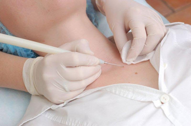 Удаление папиллом в медицинской клинике. Врач дерматолог косметолог. - Изображение #1, Объявление #1707712