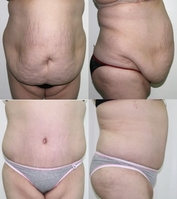 Пластические и косметические операции в клинике "Medicana" - Изображение #3, Объявление #1701146