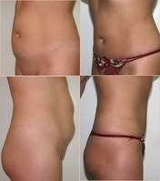 Пластические и косметические операции в клинике "Medicana" - Изображение #4, Объявление #1701146