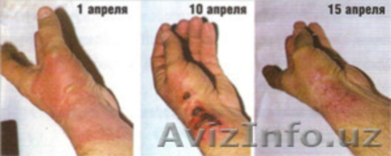 Гель Миллениум Нео (Gel Millenium Neo ). Лечение угревой сыпи. Удаление пигментн - Изображение #3, Объявление #1056420