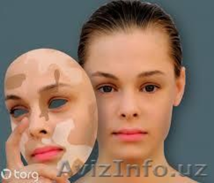 Лечение белых пятен на коже Витиксом эффектисность проверен временем!! - Изображение #6, Объявление #1140369