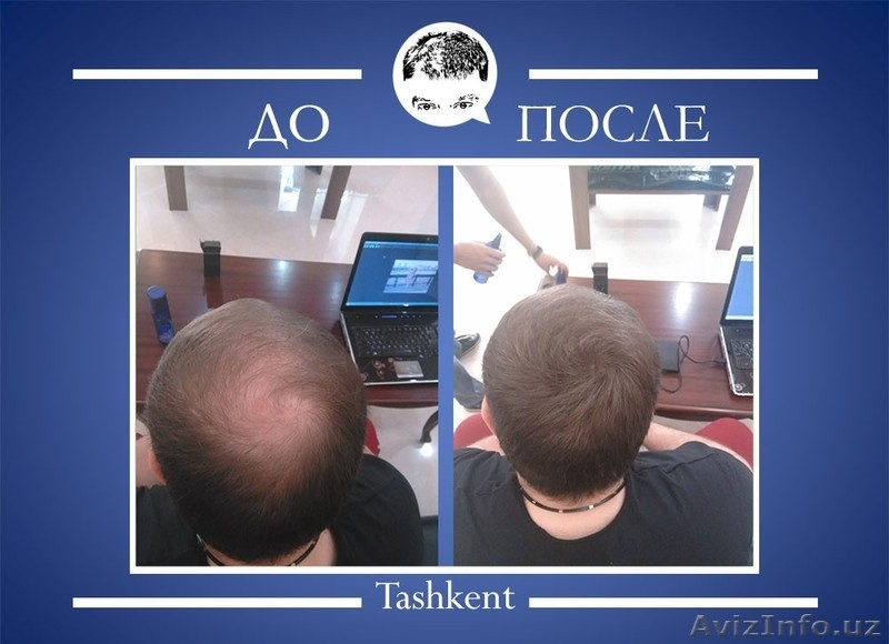 Избавься от залысин и редких волос за 30 секунд! - Изображение #3, Объявление #1172510