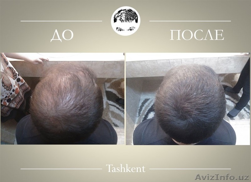 Избавься от залысин и редких волос за 30 секунд! - Изображение #4, Объявление #1172510