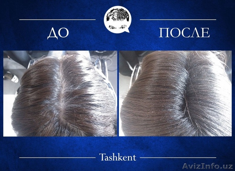 Избавься от залысин и редких волос за 30 секунд! - Изображение #6, Объявление #1172510
