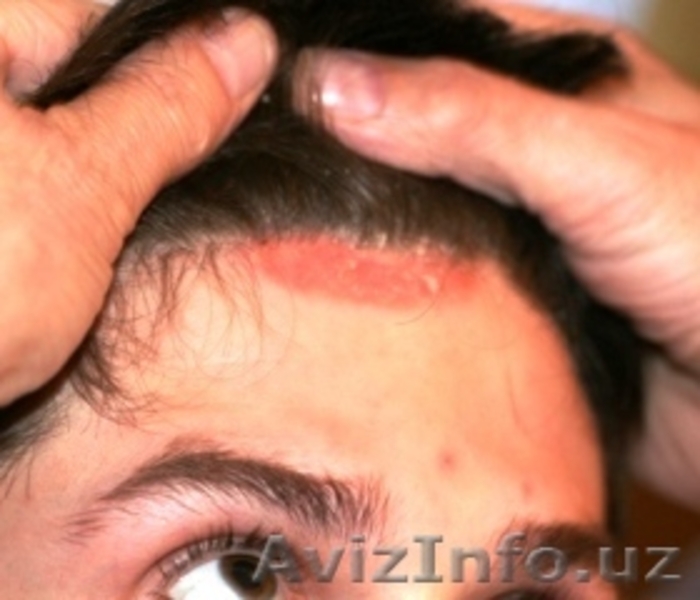 Псориаз, Чандик. Хуснбузар ва Экземани даволашга янги махсулот - Содермикс !!!  - Изображение #4, Объявление #1140386