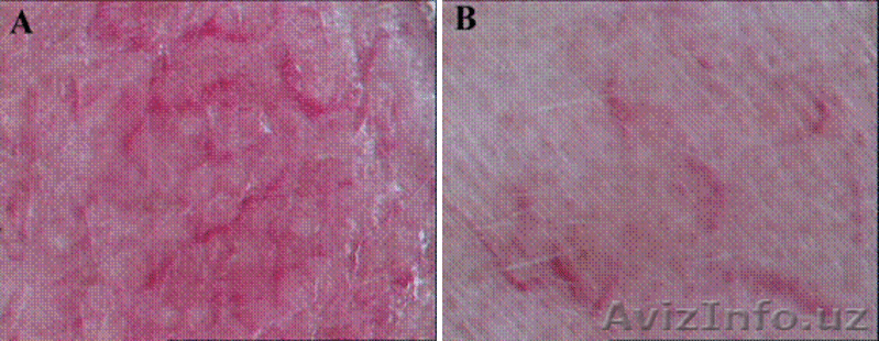 Псориаз, Чандик. Хуснбузар ва Экземани даволашга янги махсулот - Содермикс !!!  - Изображение #3, Объявление #1140386