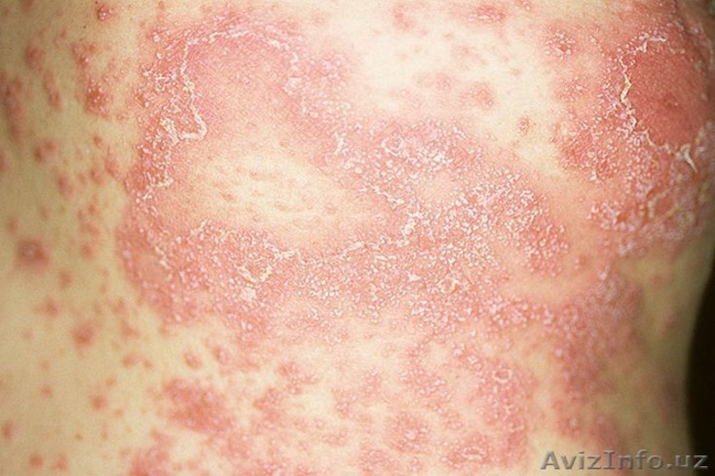 РУБЦЫ, ШРАМЫ, ПСОРИАЗ И ЭКЗЕМЫ???… ЕСТЬ СРЕДСТВО !!! - Изображение #4, Объявление #1140382
