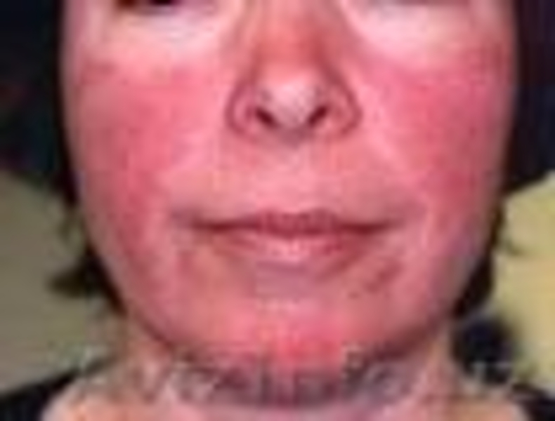 Хуснбузарлар (пушти), демодекоз, каткалокли дерматит ва юз кизаришига - Изображение #3, Объявление #1140389