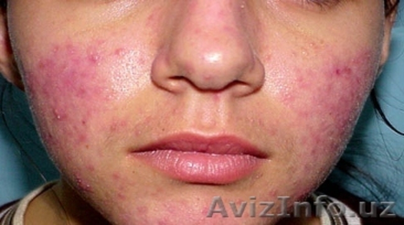 Угри -розовые и их  лечение  - Изображение #7, Объявление #1140390