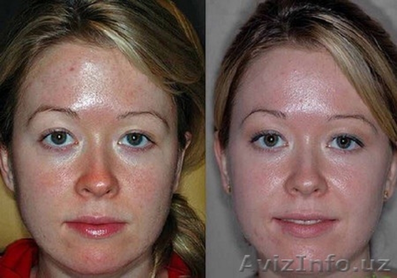 КОСМЕТОЛОГ С МЕД.образованием! ИНЪЕКЦИОННАЯ И ЭСТЕТИЧЕСКАЯ КОСМЕТОЛОГИЯ!!! - Изображение #3, Объявление #1312445