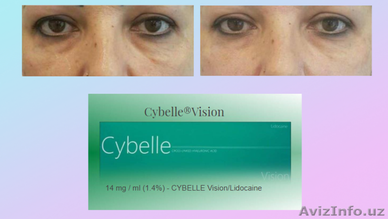инъекционные препараты премиум класса  линии Cybelle  Brillas - Изображение #7, Объявление #1624151