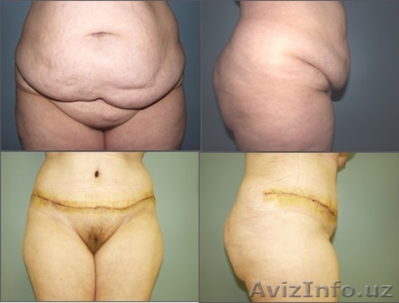 ПЛАСТИЧЕСКАЯ И ЭСТЕТИЧЕСКАЯ ХИРУРГИЯ - Изображение #6, Объявление #533305