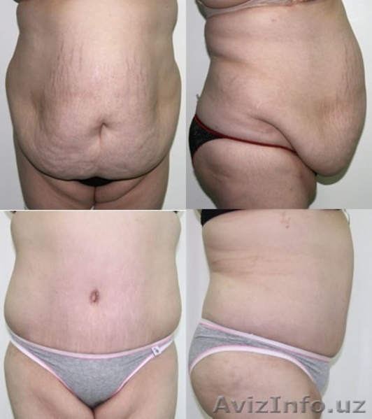 ПЛАСТИЧЕСКАЯ И ЭСТЕТИЧЕСКАЯ ХИРУРГИЯ - Изображение #7, Объявление #533305