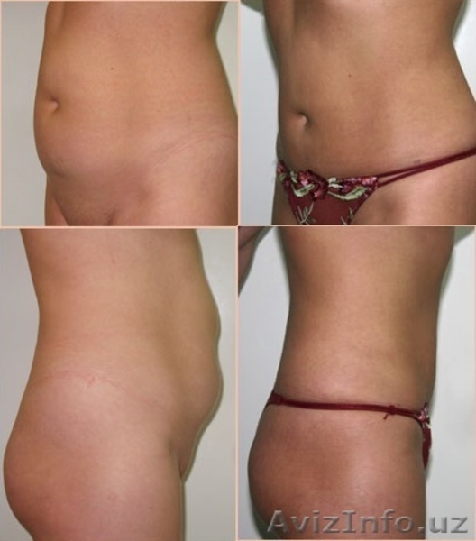 ПЛАСТИЧЕСКАЯ И ЭСТЕТИЧЕСКАЯ ХИРУРГИЯ - Изображение #8, Объявление #533305