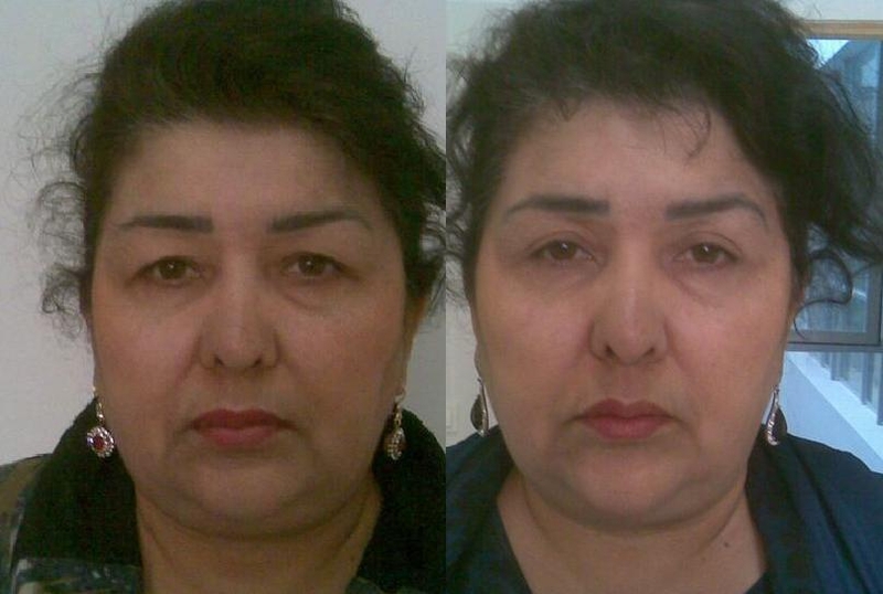 Пластические и косметические операции в клинике "Medicana" - Изображение #7, Объявление #1701146